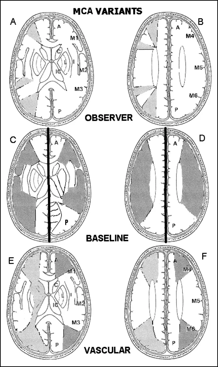 MCA variants and ASPECTS regions for stroke assessment
