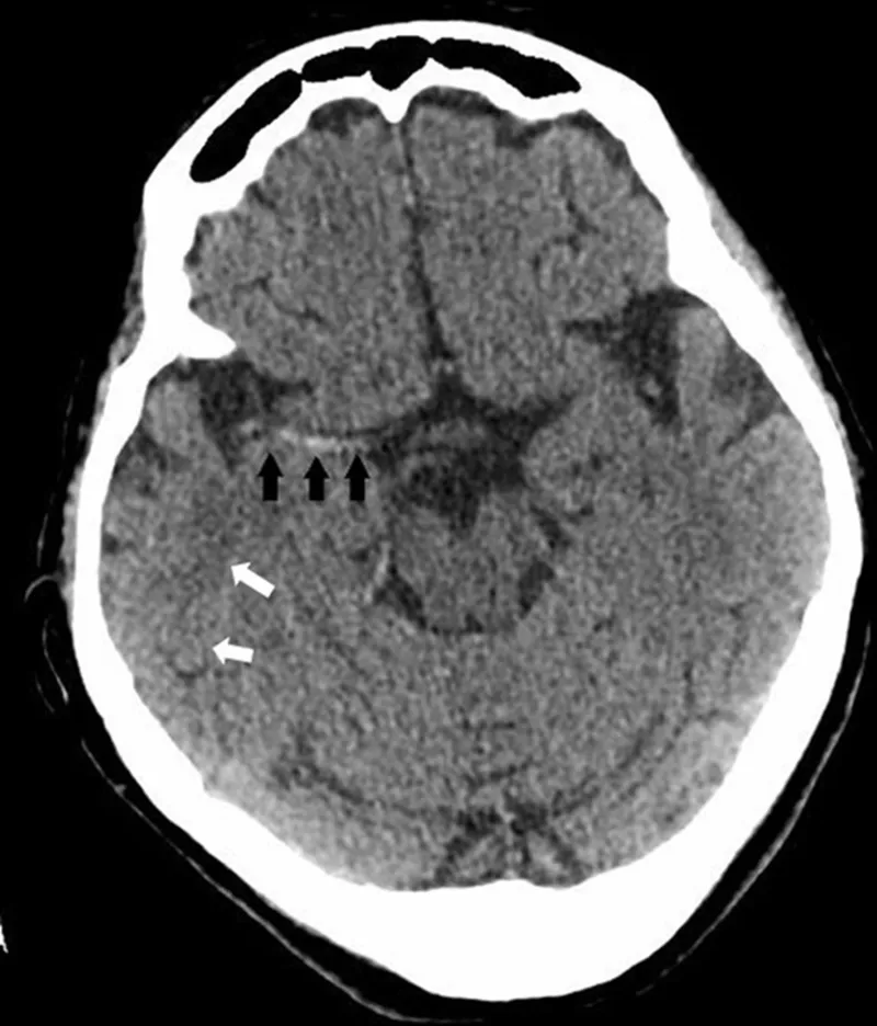 Non-contrast CT head: Hyperdense MCA sign