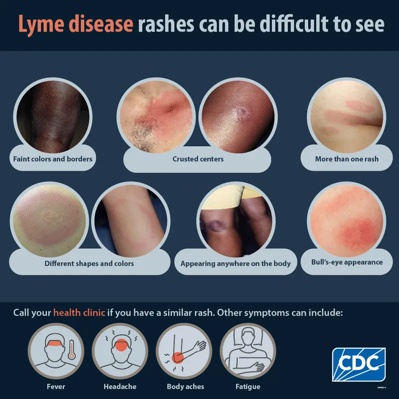 Varied presentations of Lyme disease rashes