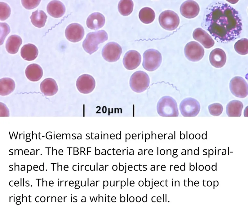 Borrelia Spirochetes in Giemsa-stained Blood Smear