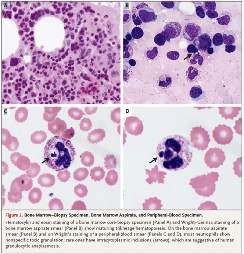 Anaplasma morulae in neutrophils