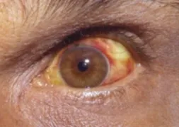Conjunctival suffusion and jaundice in Weil's disease