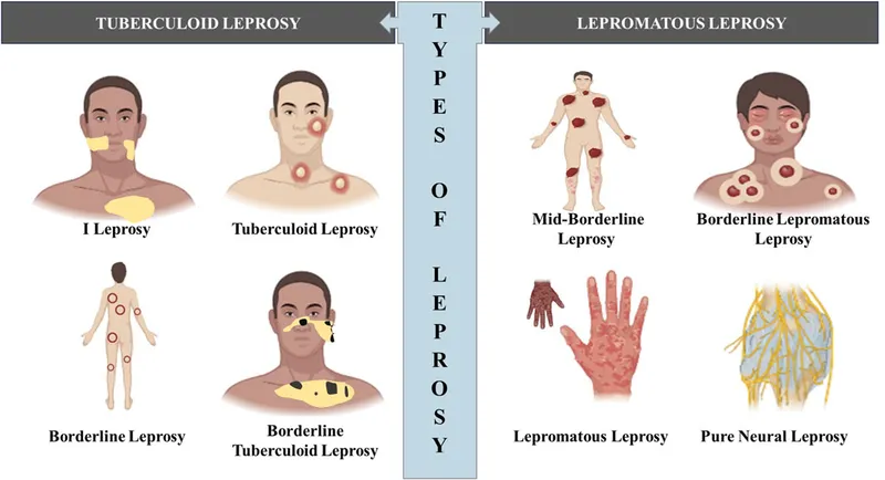 Clinical spectrum of leprosy: tuberculoid vs lepromatous