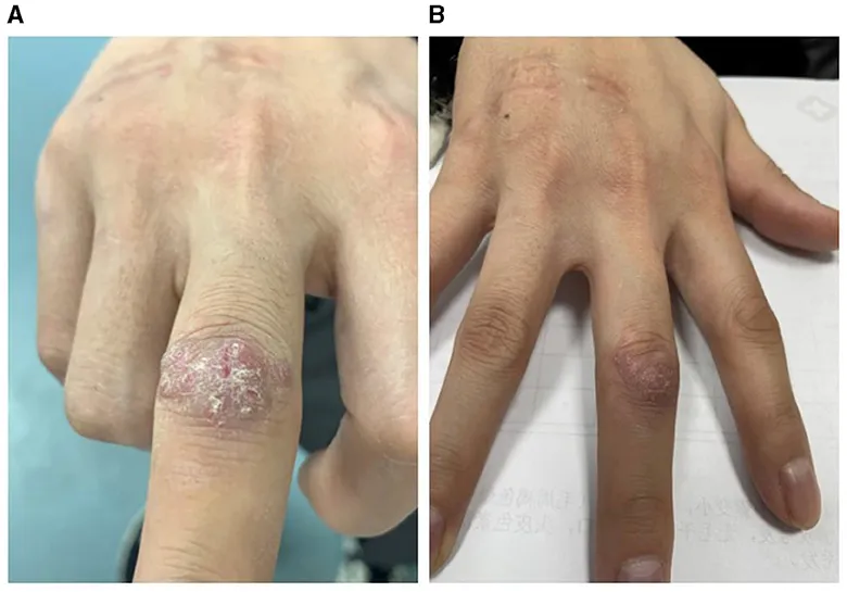 Mycobacterium marinum infection on finger, before and after