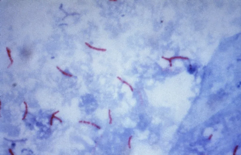 Mycobacterium tuberculosis: Acid-fast bacilli