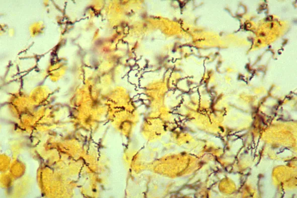 Darkfield microscopy of Treponema pallidum spirochetes