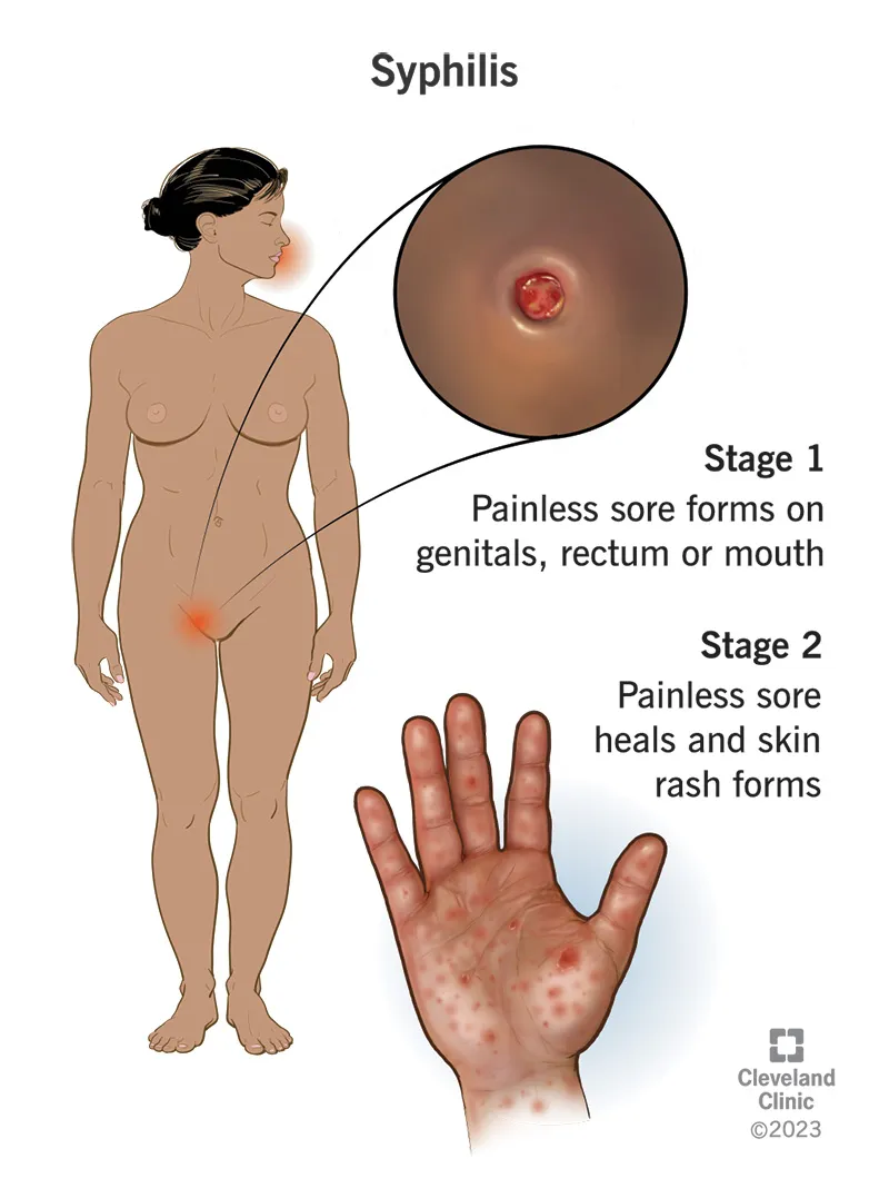 Syphilis Stages 1 and 2: Chancre and Rash