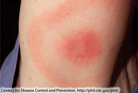 Lyme disease: Erythema migrans rash