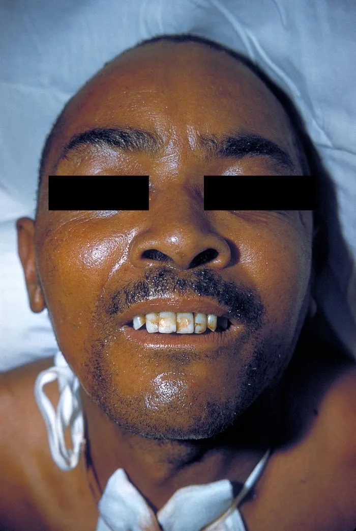 Risus sardonicus in tetanus patient