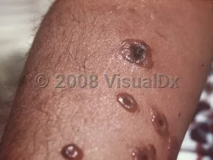 Cutaneous anthrax black eschar
