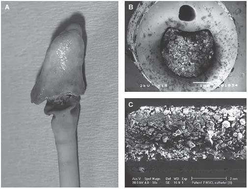 Biofilm on indwelling medical catheter, SEM