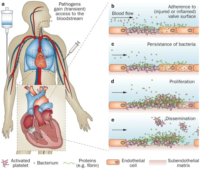Biofilm formation in infective endocarditis