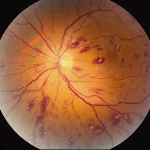 Fundoscopy showing Roth spots in endocarditis