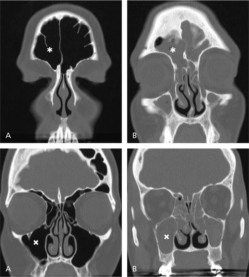 Coronal CT scans of chronic rhinosinusitis