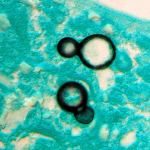 Blastomyces dermatitidis broad-based budding yeast