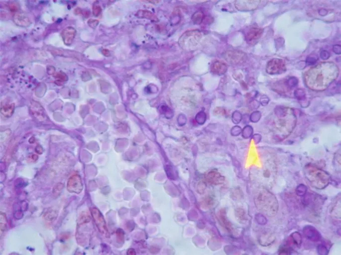 Histoplasma capsulatum yeast cells within a macrophage