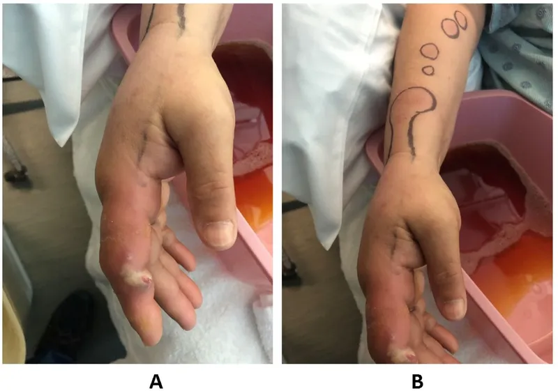 Lymphocutaneous sporotrichosis with lymphatic spread