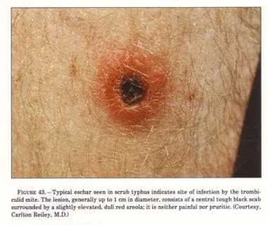 Scrub Typhus Eschar from Trombiculid Mite Bite