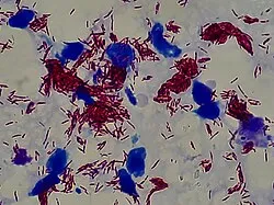 Ziehl-Neelsen stain of acid-fast bacilli