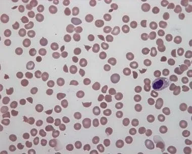 Peripheral blood smear showing schistocytes in HUS