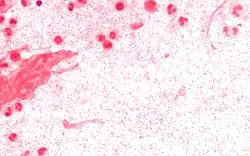 Gram stain of Haemophilus influenzae coccobacilli