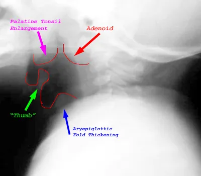 Lateral neck X-ray: Epiglottitis "thumb sign"