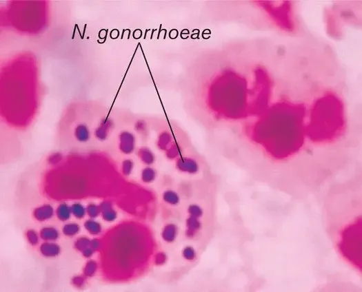 Gram stain of N. gonorrhoeae in neutrophil