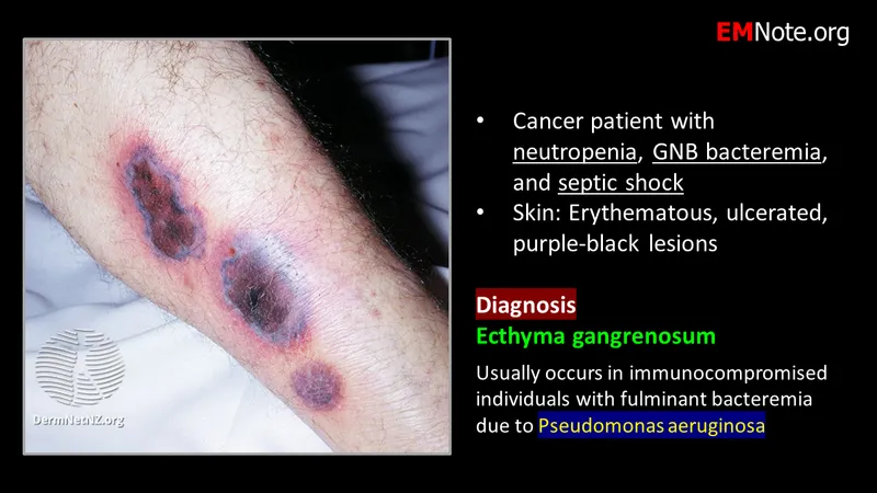 Ecthyma gangrenosum from Pseudomonas aeruginosa