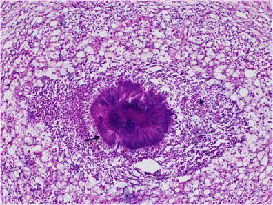 Actinomyces sulfur granule in tissue