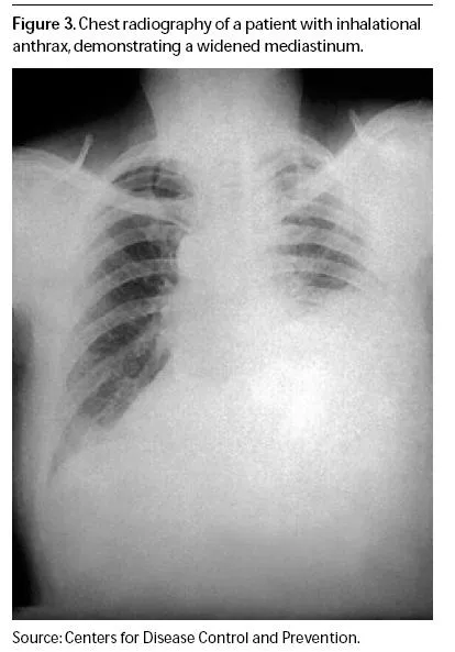 Chest X-ray: Widened mediastinum in inhalational anthrax