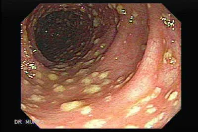Pseudomembranous colitis on colonoscopy