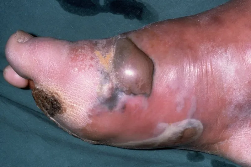 Gas gangrene of foot with bullae and skin discoloration
