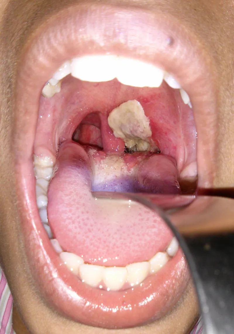 Pharyngeal pseudomembrane in diphtheria