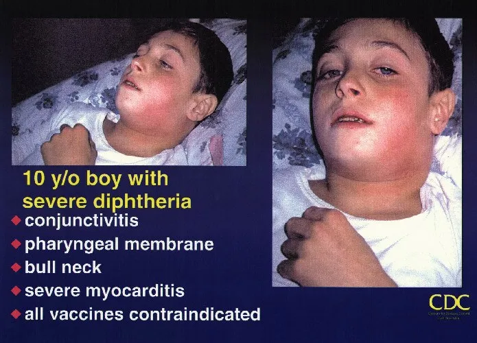 Diphtheria: Bull Neck and Pharyngeal Pseudomembrane