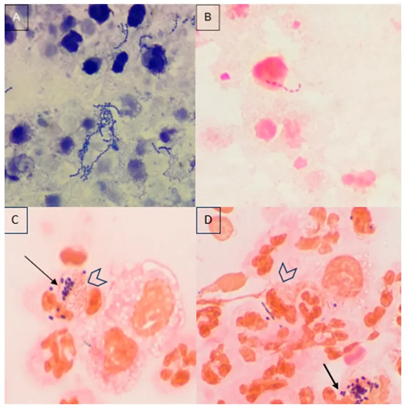 Enterococcus Gram Stain with Neutrophils and Phagocytosis
