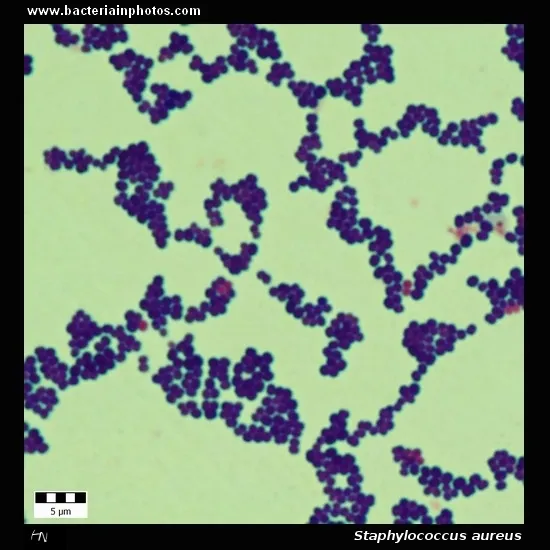 Staphylococcus aureus Gram stain: grape-like clusters