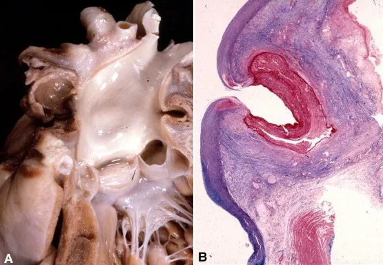 Bacterial endocarditis vegetations: gross and microscopic