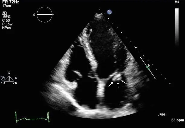 Echocardiogram: Mitral valve vegetations in endocarditis
