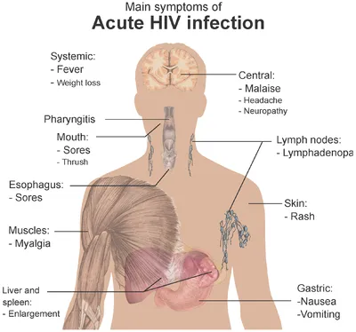 Symptoms of Acute HIV Infection