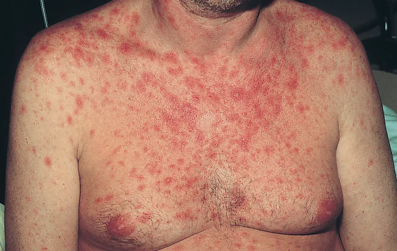 Maculopapular rash in acute HIV seroconversion syndrome