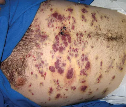 Kaposi sarcoma lesions on abdomen of AIDS patient