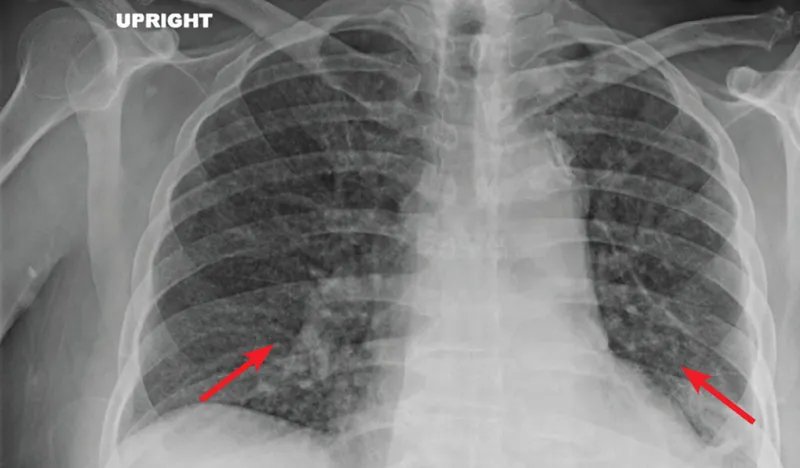Chest X-ray: Miliary TB in HIV-positive patient