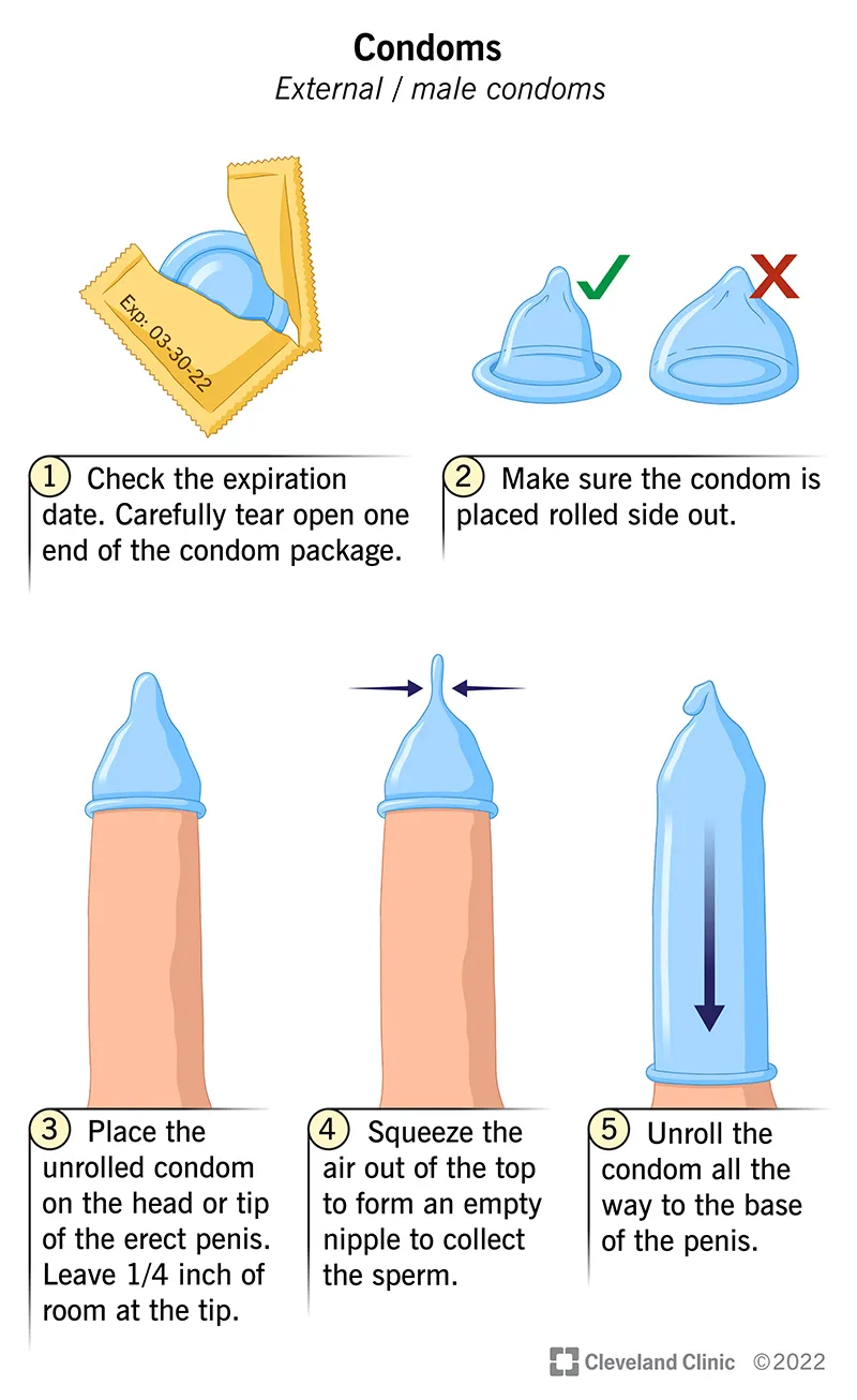 Steps for correct external condom use