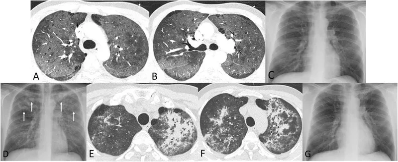 Pneumocystis jirovecii pneumonia (PJP) chest imaging