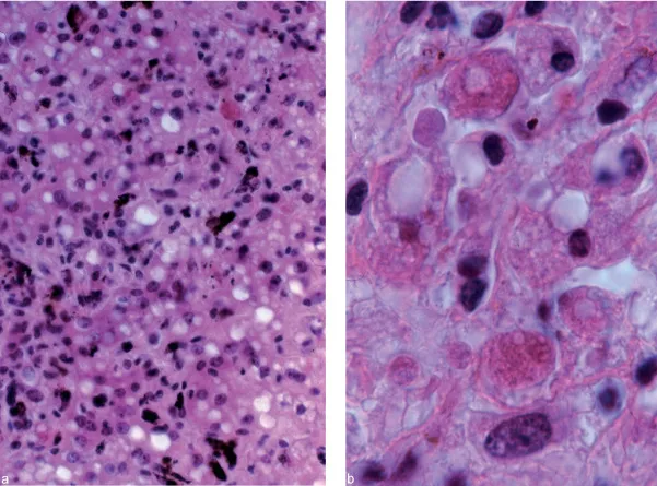 Acute Hepatitis B: Liver Histology