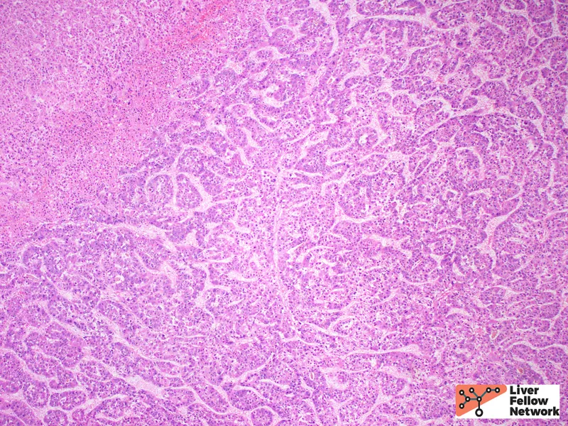 Hepatocellular Carcinoma in HBV/HCV Co-infection