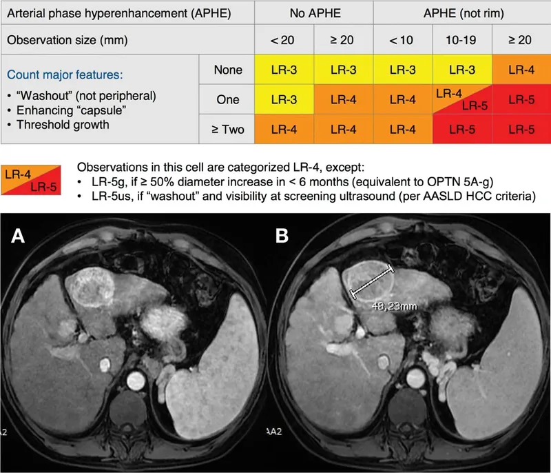 LI-RADS Table and CT Scans of HCC Lesion