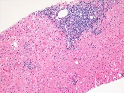 Liver biopsy: Chronic Hepatitis C with inflammation