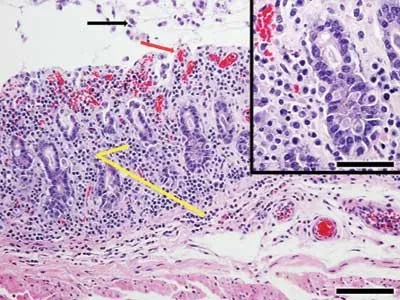 C. difficile colitis: pseudomembrane and inflammation