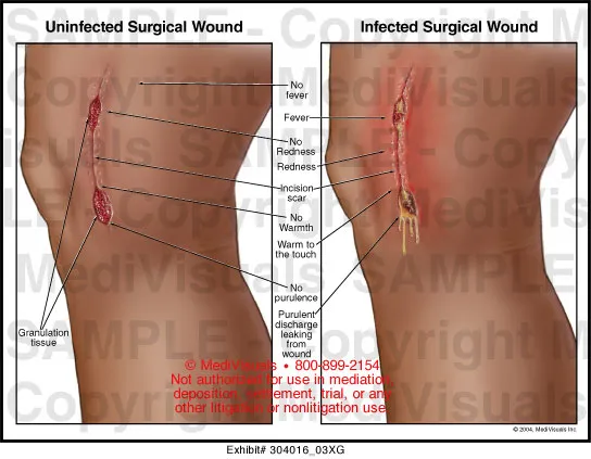 Uninfected vs. Infected Surgical Wound